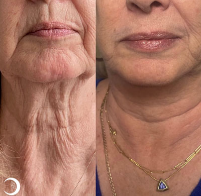 Before and After Images of Clients at True Medical Aesthetics in Avon, CT