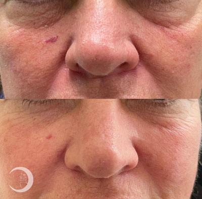 Before and After Images of Clients at True Medical Aesthetics in Avon, CT