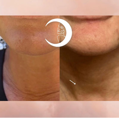 Before and After Images of Clients at True Medical Aesthetics in Avon, CT
