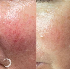 Before and After Images of Clients at True Medical Aesthetics in Avon, CT