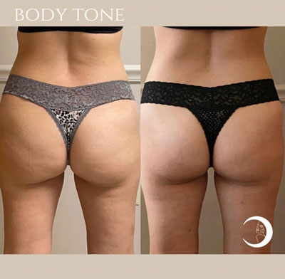 Before and After Images of Clients at True Medical Aesthetics in Avon, CT