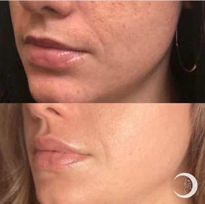 Before and After Images of Clients at True Medical Aesthetics in Avon, CT