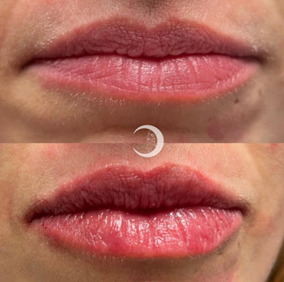 Before and After Images of Clients at True Medical Aesthetics in Avon, CT