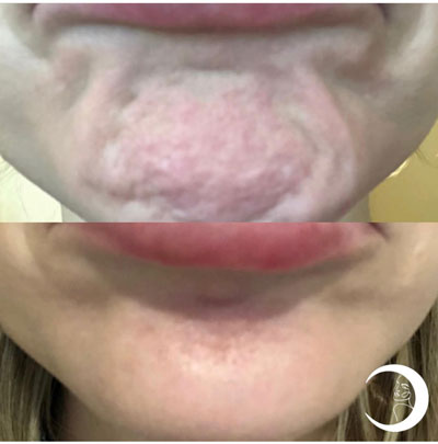 Before and After Images of Clients at True Medical Aesthetics in Avon, CT