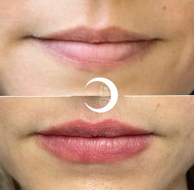 Before and After Images of Clients at True Medical Aesthetics in Avon, CT
