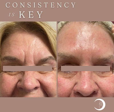 Before and After Images of Clients at True Medical Aesthetics in Avon, CT