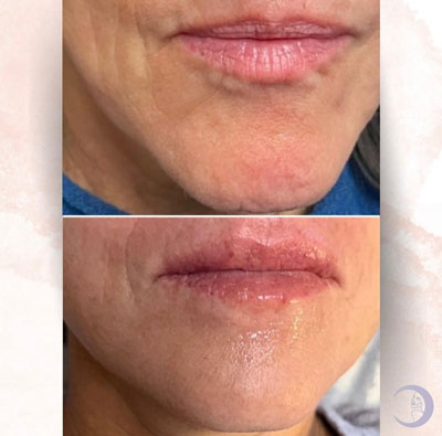 Before and After Images of Clients at True Medical Aesthetics in Avon, CT
