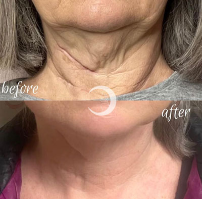 Before and After Images of Clients at True Medical Aesthetics in Avon, CT