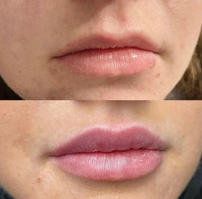 Before and After Images of Clients at True Medical Aesthetics in Avon, CT