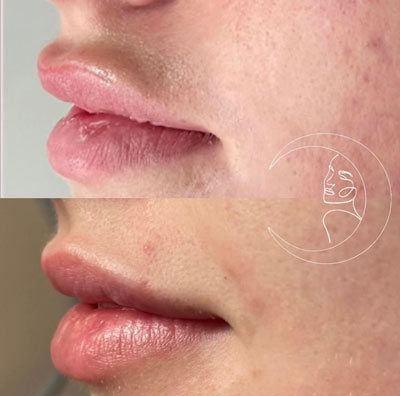 Before and After Images of Clients at True Medical Aesthetics in Avon, CT