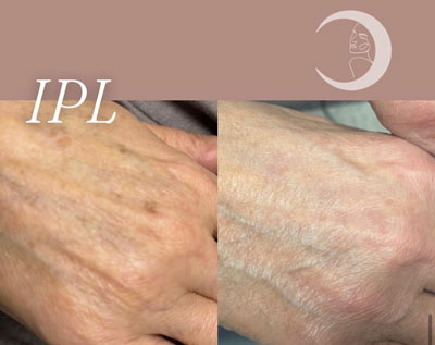 Before and After Images of Clients at True Medical Aesthetics in Avon, CT