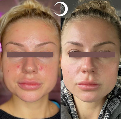Before and After Images of Clients at True Medical Aesthetics in Avon, CT