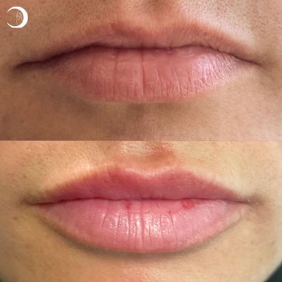 Before and After Images of Clients at True Medical Aesthetics in Avon, CT
