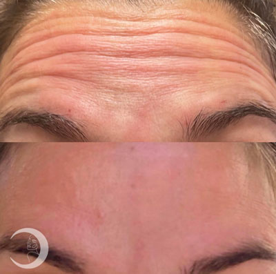 Before and After Images of Clients at True Medical Aesthetics in Avon, CT