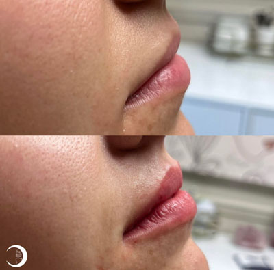Before and After Images of Clients at True Medical Aesthetics in Avon, CT