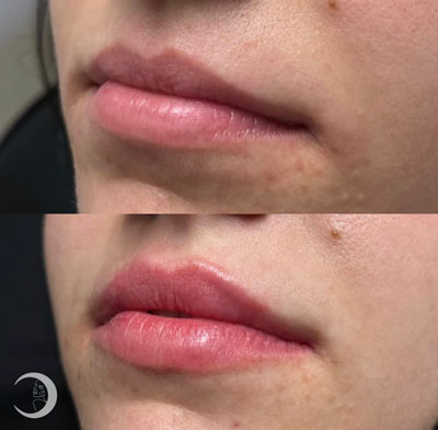 Before and After Images of Clients at True Medical Aesthetics in Avon, CT