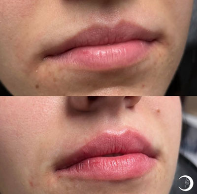 Before and After Images of Clients at True Medical Aesthetics in Avon, CT