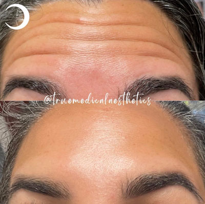 Before and After Images of Clients at True Medical Aesthetics in Avon, CT