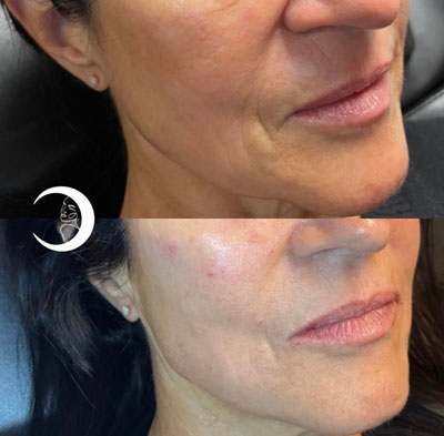 Before and After Images of Clients at True Medical Aesthetics in Avon, CT