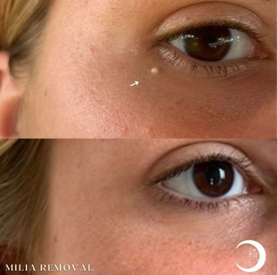 Before and After Images of Clients at True Medical Aesthetics in Avon, CT