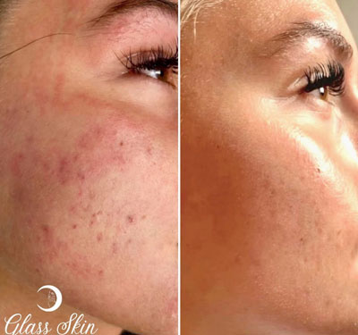 Before and After Images of Clients at True Medical Aesthetics in Avon, CT