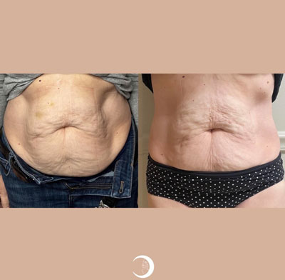 Before and After Images of Clients at True Medical Aesthetics in Avon, CT