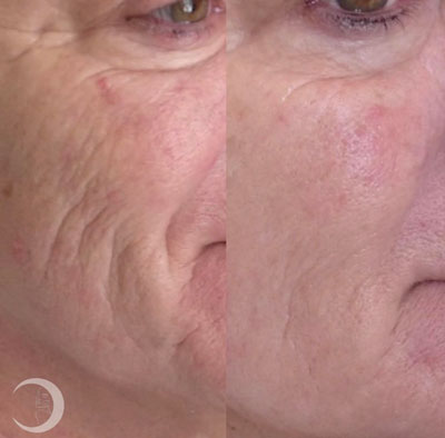 Before and After Images of Clients at True Medical Aesthetics in Avon, CT