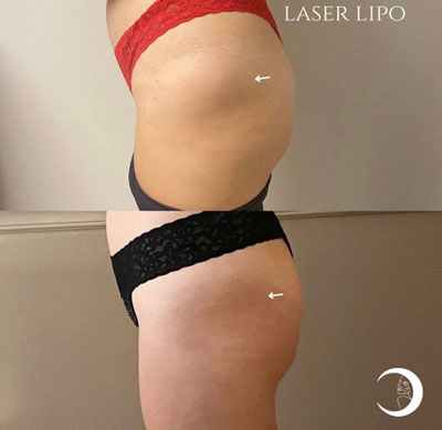 Before and After Images of Clients at True Medical Aesthetics in Avon, CT