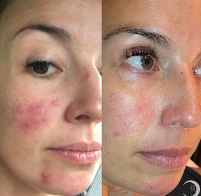 Before and After Images of Clients at True Medical Aesthetics in Avon, CT