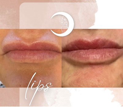 Before and After Images of Clients at True Medical Aesthetics in Avon, CT