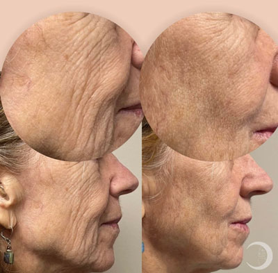 Before and After Images of Clients at True Medical Aesthetics in Avon, CT