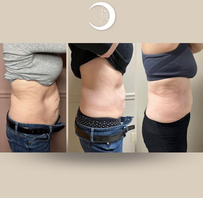 Before and After Images of Clients at True Medical Aesthetics in Avon, CT