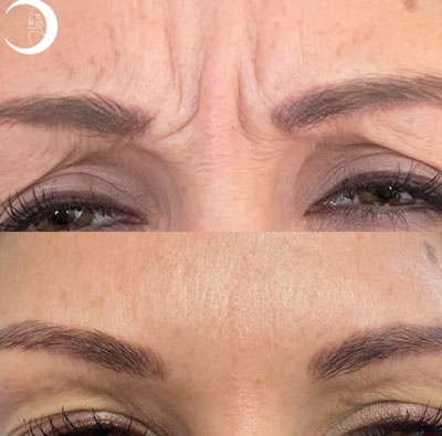 Before and After Images of Clients at True Medical Aesthetics in Avon, CT