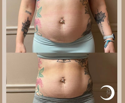 Before and After Images of True Medical Aesthetics in Avon, CT