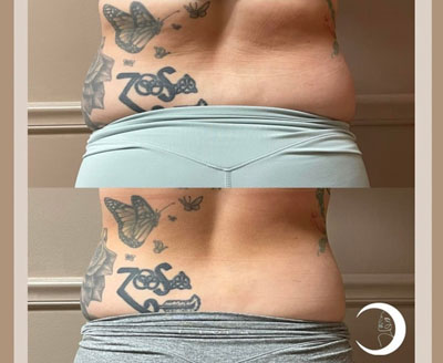 Before and After Images of Clients at True Medical Aesthetics in Avon, CT