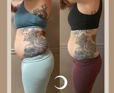 Before and After Images of Clients at True Medical Aesthetics in Avon, CT