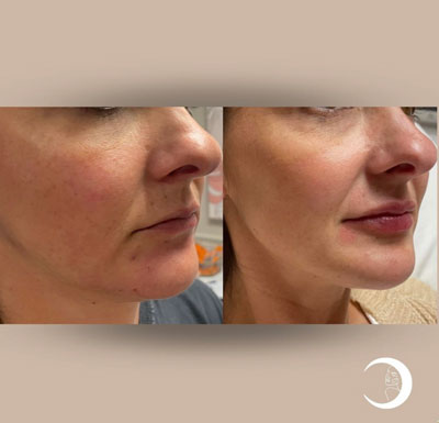 Before and After Images of Clients at True Medical Aesthetics in Avon, CT