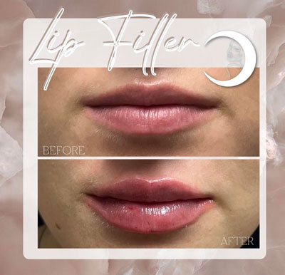 Before and After Images of Clients at True Medical Aesthetics in Avon, CT