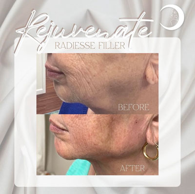 Before and After Images of Clients at True Medical Aesthetics in Avon, CT