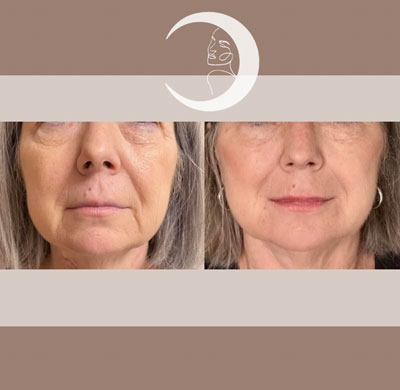 Before and After Images of Clients at True Medical Aesthetics in Avon, CT