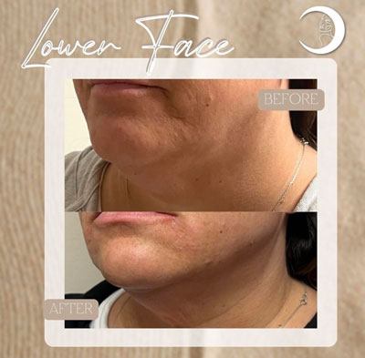 Before and After Images of Clients at True Medical Aesthetics in Avon, CT