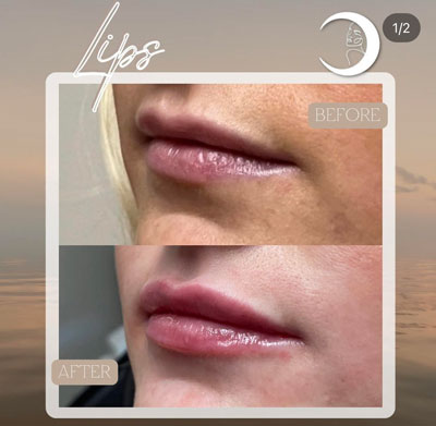 Before and After Images of Clients at True Medical Aesthetics in Avon, CT