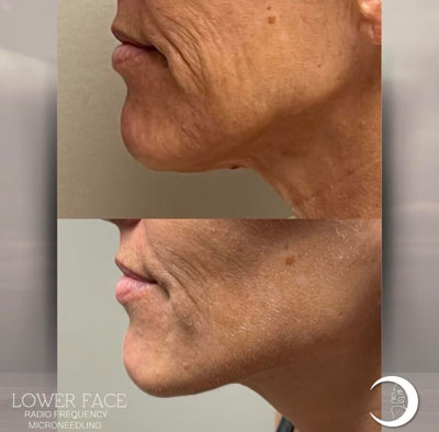 Before and After Images of Clients at True Medical Aesthetics in Avon, CT
