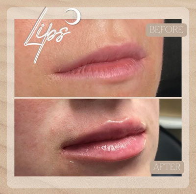 Before and After Images of Clients at True Medical Aesthetics in Avon, CT