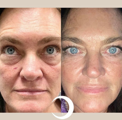 Before and After Images of Clients at True Medical Aesthetics in Avon, CT