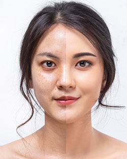 IPL Pigment Removal Near Me in Avon, CT IPL Pigment Removal Near Me in Avon, CT