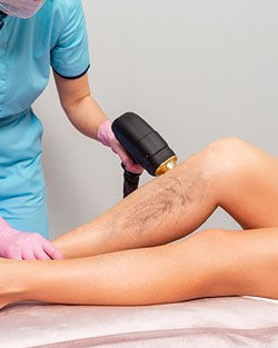 Laser Vein Removal Near Me in Avon, CT Laser Vein Removal Near Me in Avon, CT
