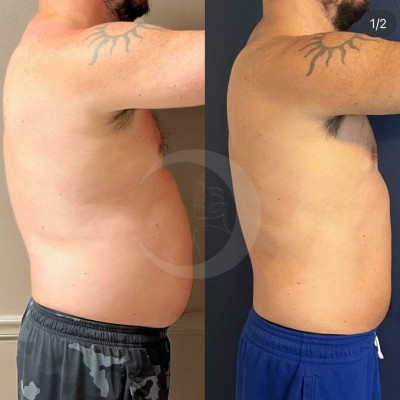 Before and After Images of Clients at True Medical Aesthetics in Avon, CT