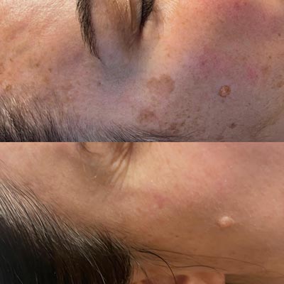 Before and After Images of Clients at True Medical Aesthetics in Avon, CT