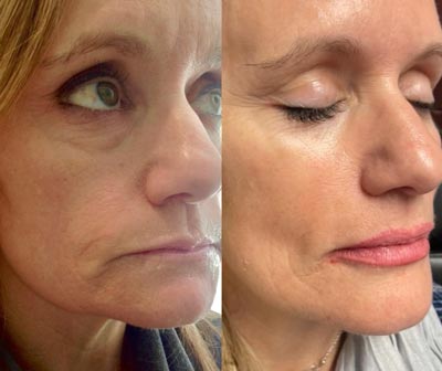 Before and After Images of Clients at True Medical Aesthetics in Avon, CT